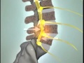 Spondylolisthesis - DePuy Videos