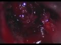 Sublabial transphenoidal resection of pituitary tumor