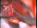 Retrosigmoid approach for resection of petroclival meningioma