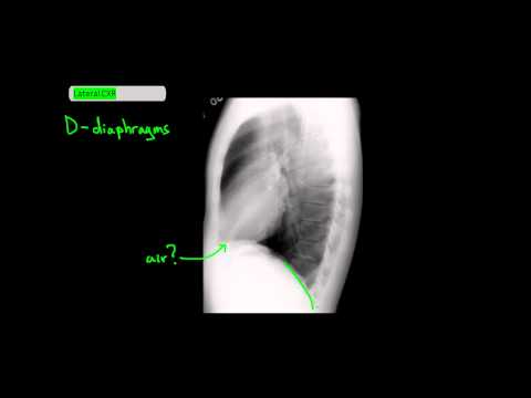 how to read chest x ray