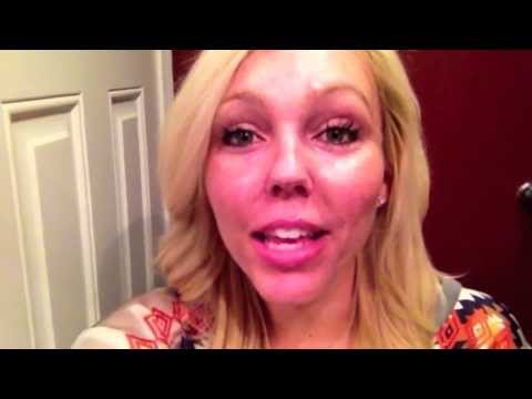 Fractional CO2 Laser Review- 1 year after