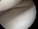 Meniscus Surgery