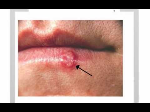how to cure oral herpes