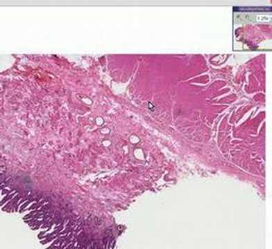 Histopathology Esophagus  --Barrett ...