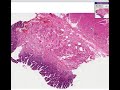 Histopathology Esophagus  --Barrett esophagus