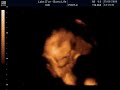 Ultra-sonografia III 3D - Cec�lia