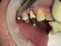 Immediate Implant/Provisional; Physics Forceps