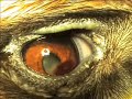Co�gulo en c�mara anterior posterior a un hipema