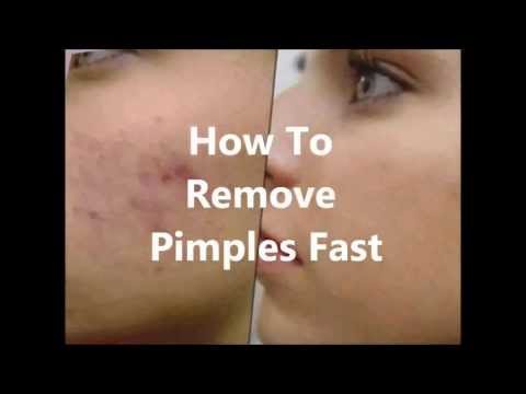 how to remove pimples