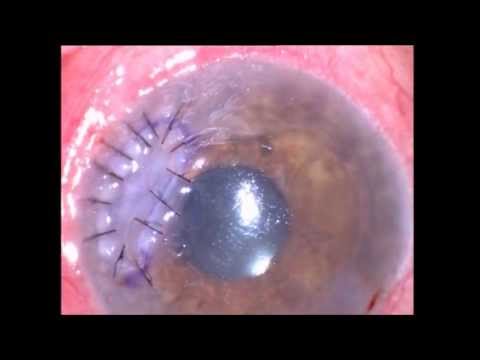 how to patch eye for corneal abrasion