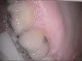See Video