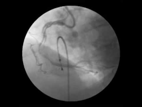how to isolate epicardial pacing wires