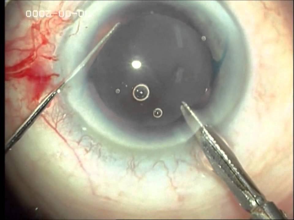 Explante de lente intraocular opacificada