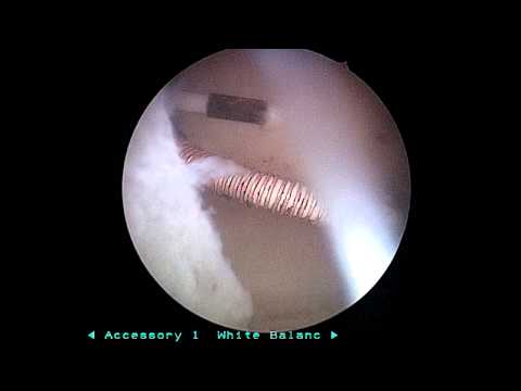 how to remove copper t