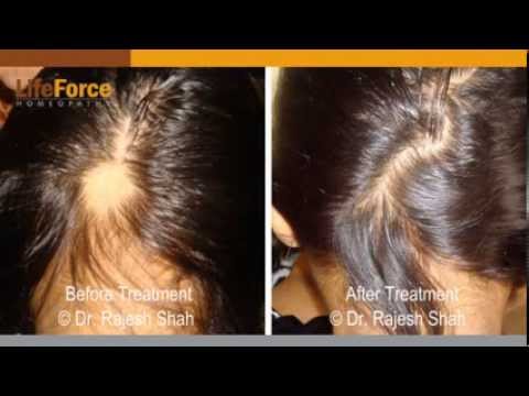 how to treat alopecia x