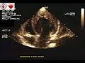 echocardiography video echocardiography video