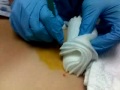 Pilonidal cyst