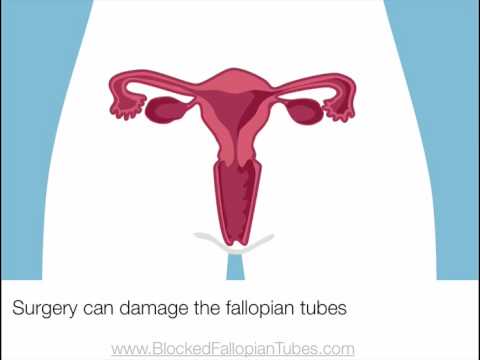 how to unclog fallopian tubes