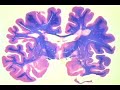Multiple Sclerosis