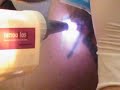 Tattooentfernung Laserbehandlung bei tattoo[los]