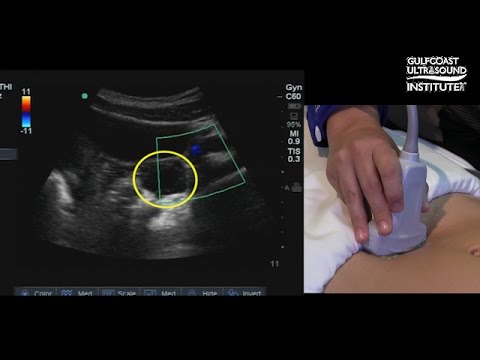 how to locate ovaries on ultrasound
