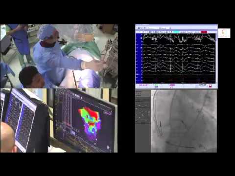 how to perform vt ablation