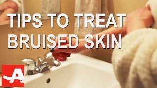 Ways to Treat Skin that Bruises