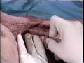 Axillary Block using Nerve Stimulator