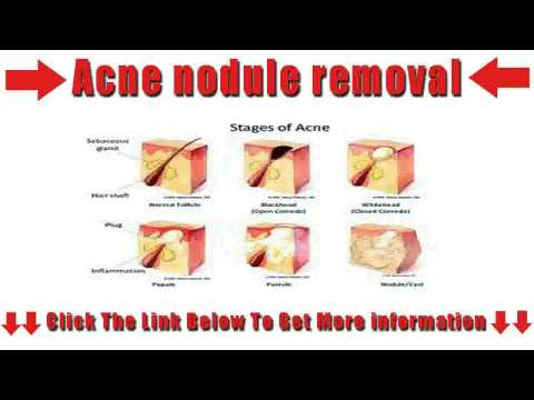 how to treat nodular acne