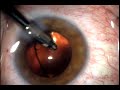 Multifocal Restor IOL SN60D3 implantation Multifocal Restor IOL SN60D3 implantation