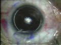 LASIK
