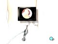 PreOp® Patient Education Spleen Removal Laparoscopic Splenectomy Surgery 2