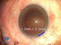 Surgically Induced Astigmatism Phaco 3.1 Complications