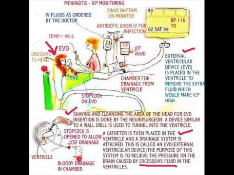how to measure csf pressure