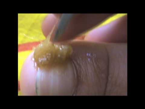 El tratamiento de las uñas encarnadas en los pies en minske