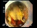 Radiofrequency Ablation Of Halo 360 Method After Endoscopic Mucosal Removal Of Cancerous Nodule. Radiofrequency Ablation Of Halo 360 Method After Endoscopic Mucosal Removal Of Cancerous Nodule.