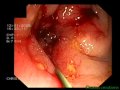 COLORECTAL STENT KARALIS 256DVD.mpg