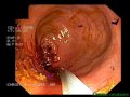 Stent Placement, Colorectal Cancer Stent Placement, Colorectal Cancer