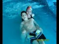 Sindrome de Angelman
