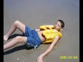 Sindrome de Angelman