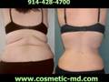 Liposuction Connecticut