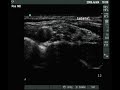Ultrasound views of the brachial plexus (supraclavicular)