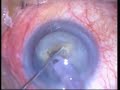 Phaco-Ozil-Hard-cataract Phaco-Ozil-Hard-cataract