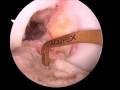 Anterior Cruciate... View Video