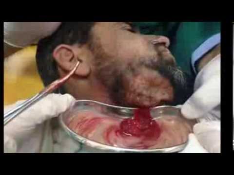 how to drain tooth abscess