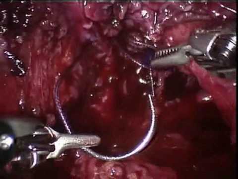 Partial Urinary Bladder Endoscopy With Bladder Diverticulum Removal (Robotically-Assisted And Laparoscopic) (2/3)