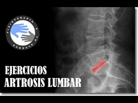 La osteocondrosis del departamento lumbar de la columna vertebral los síntomas a las mujeres