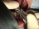 NobelActive Implant  Immediate Function