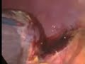 Laparoscopic Splenectomy Laparoscopic Splenectomy