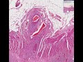 Histopathology Small intestine--Rheumatoid vasculitis